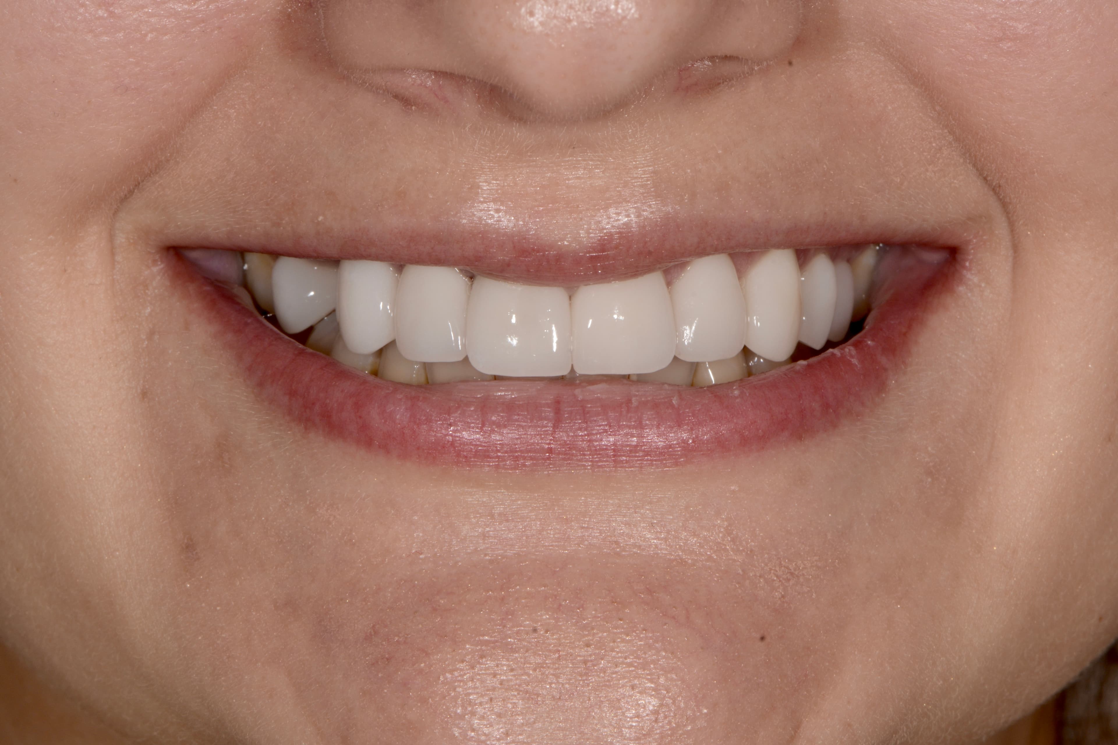 After porcelain crowns and veneers: uniform, natural-looking smile