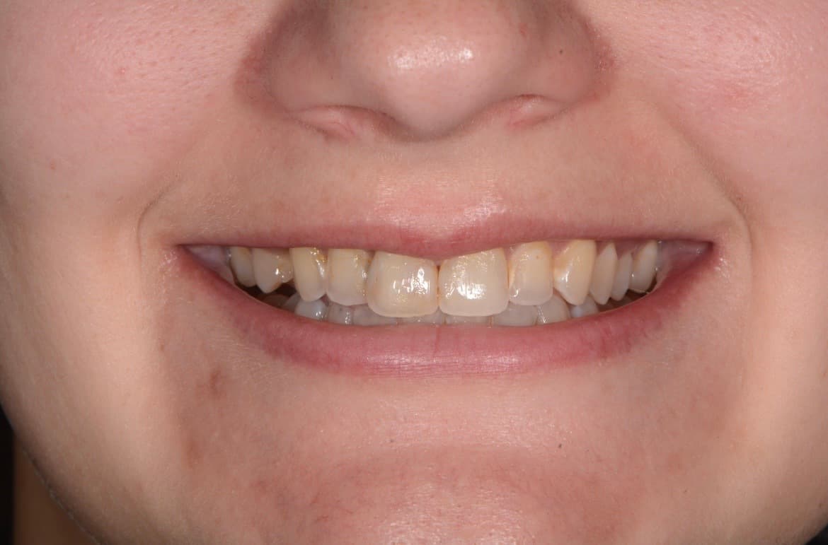 Before porcelain crowns and veneers: worn, discolored teeth